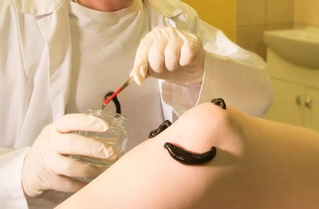 Hirudotherapie voor spataderen