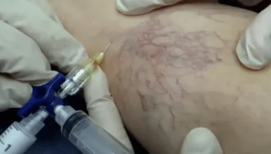 sclerotherapie voor spataderen