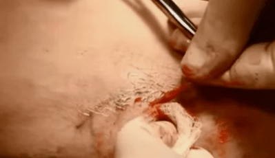 soorten operaties om spataderen te verwijderen