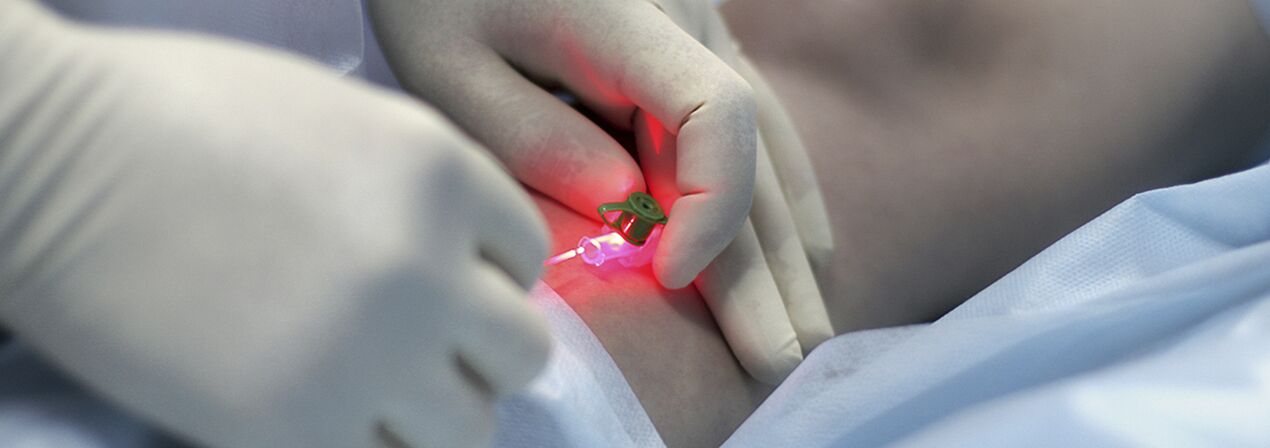 Compressie-sclerotherapie