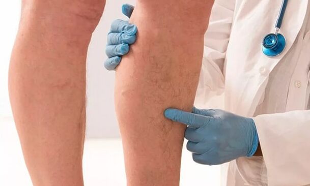 dokter onderzoekt benen op spataderen